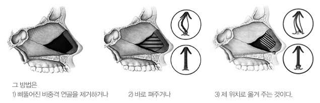 휜 코, 비중격까지 함께 봐야 하는 이유