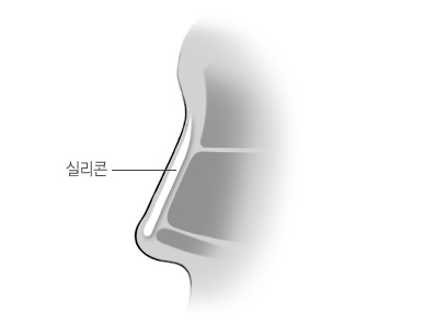 일체형 융비술
