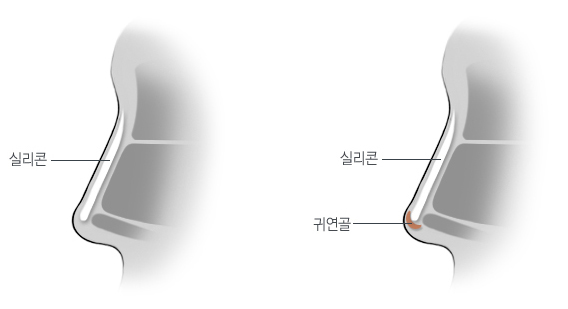 분리형 코성형이 부작용을 줄이는 원리