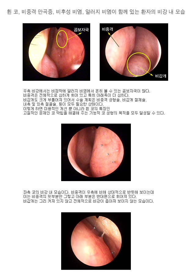 휜코, 비중격만곡증, 비후성 비염, 알러지비염이 있는 환자의 비강내 모습