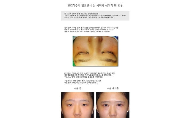 안검하수가 있으면서 눈 사이가 심하게 먼 경우, 수술 후 2주
