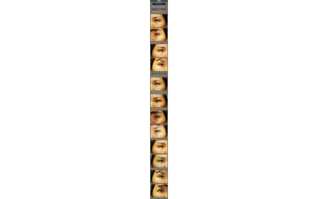 뒤트임 재건 사례 2