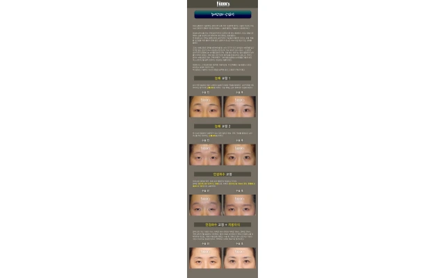 눈매교정과 안검하수