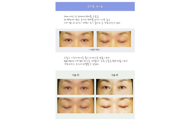 50대 여성의 4번째 쌍꺼풀 재수술