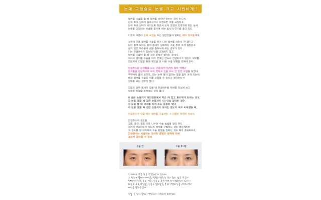눈매 교정술로 눈을 크고 시원하게!!