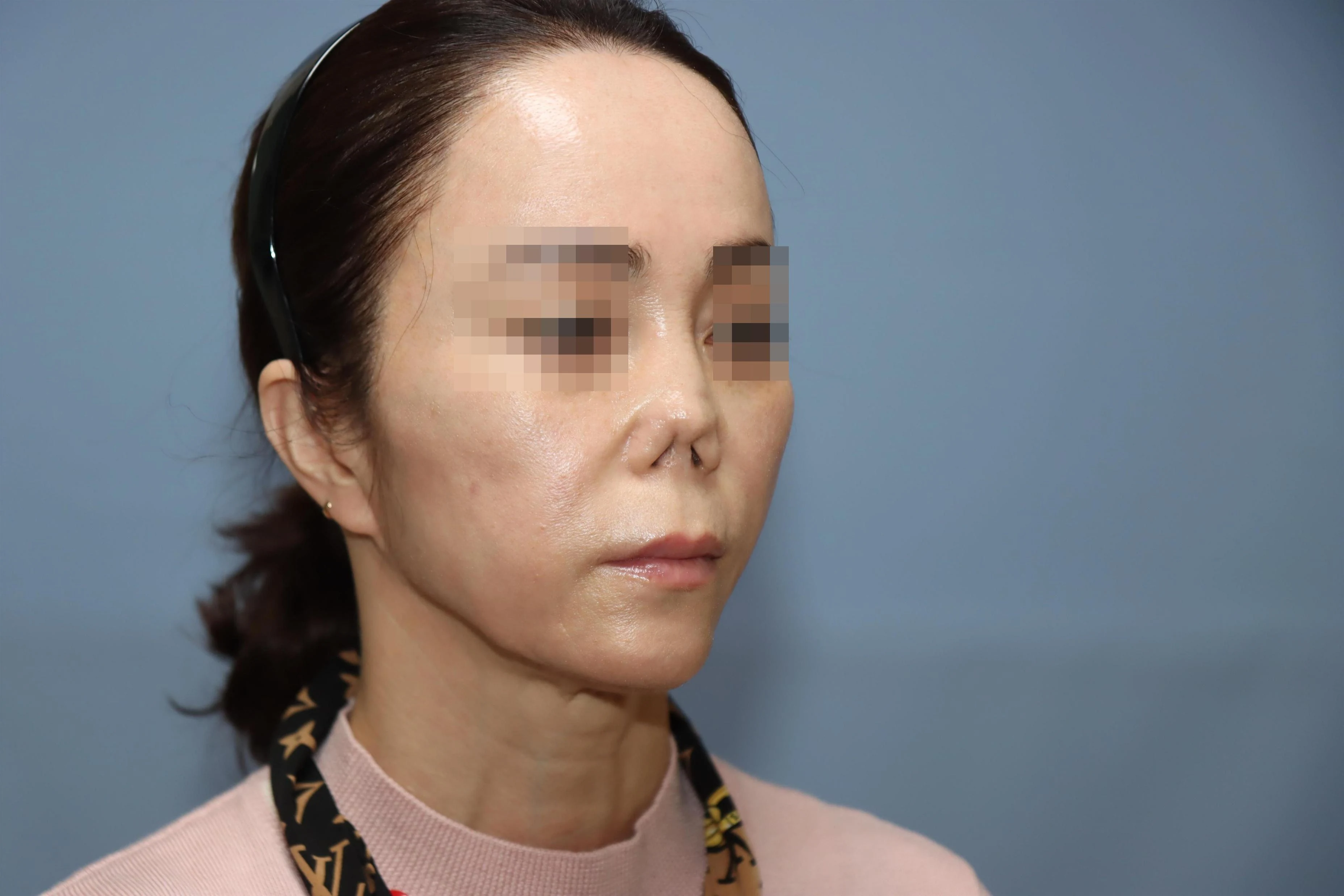 줄기세포 코성형 제거 후 5달 비교 사진 3