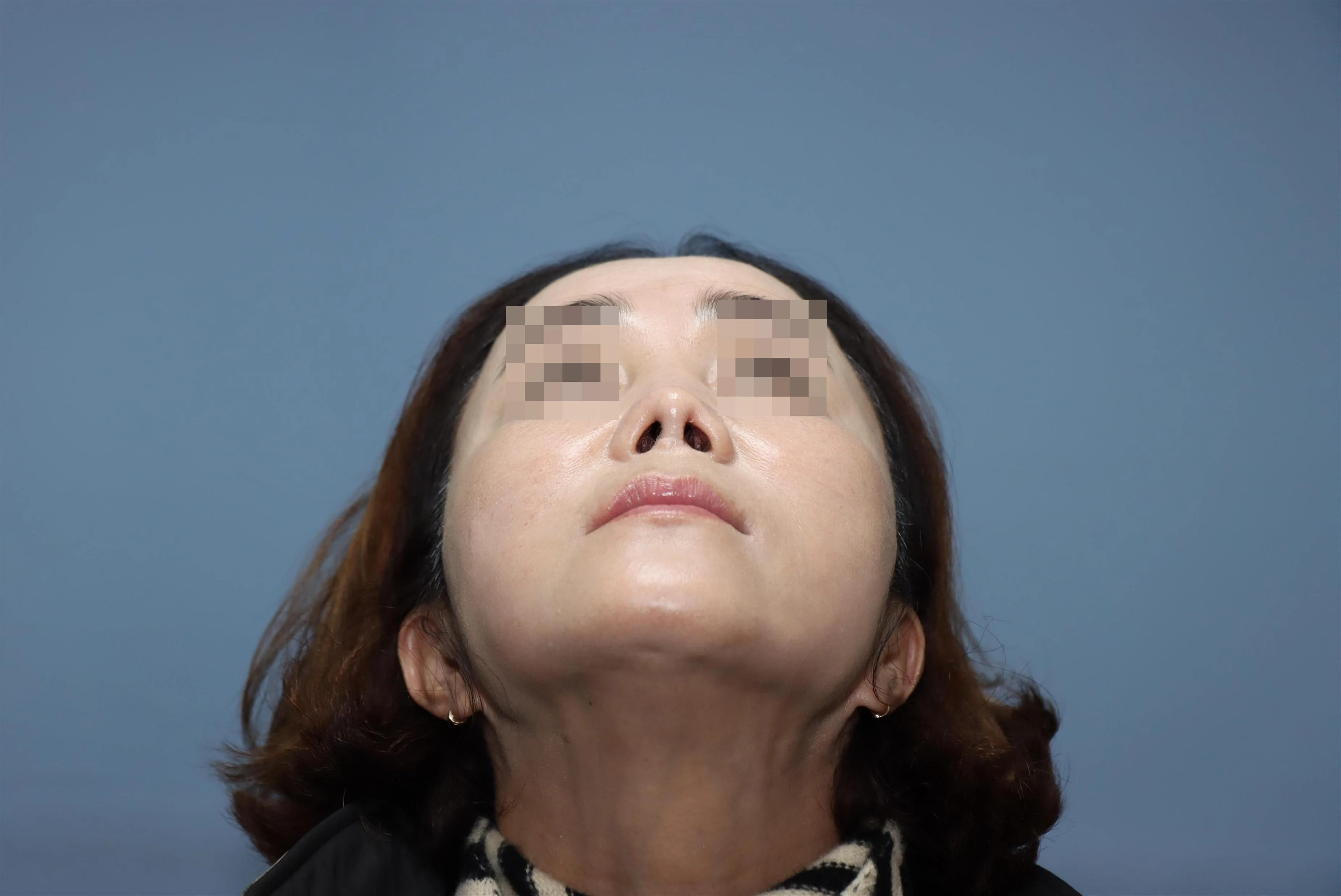 줄기세포 코성형 재건 수술 후 비교 사진 2