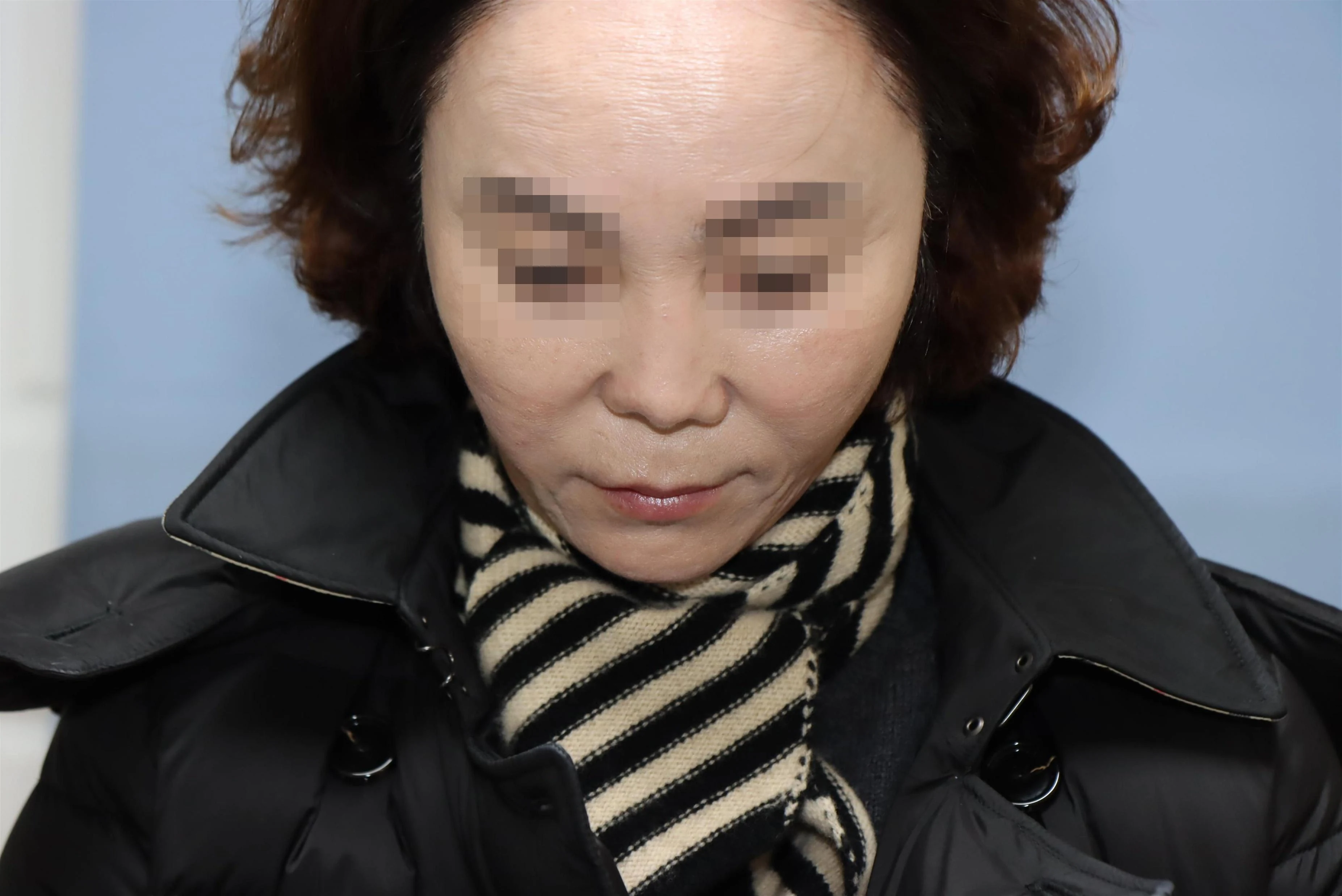 줄기세포 코성형 재건 수술 후 비교 사진 2