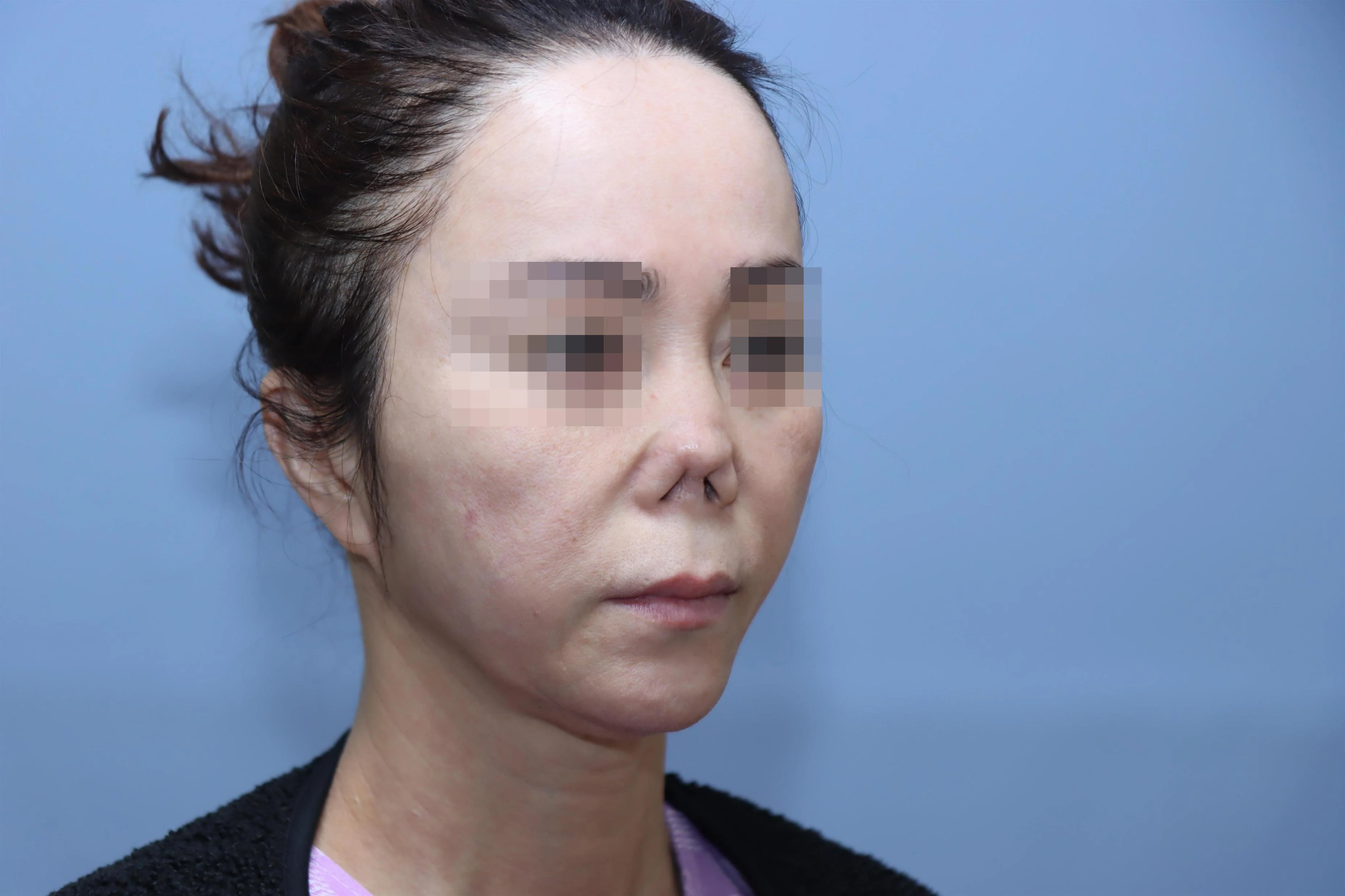 줄기세포 코성형 수술 전 비교 사진 1