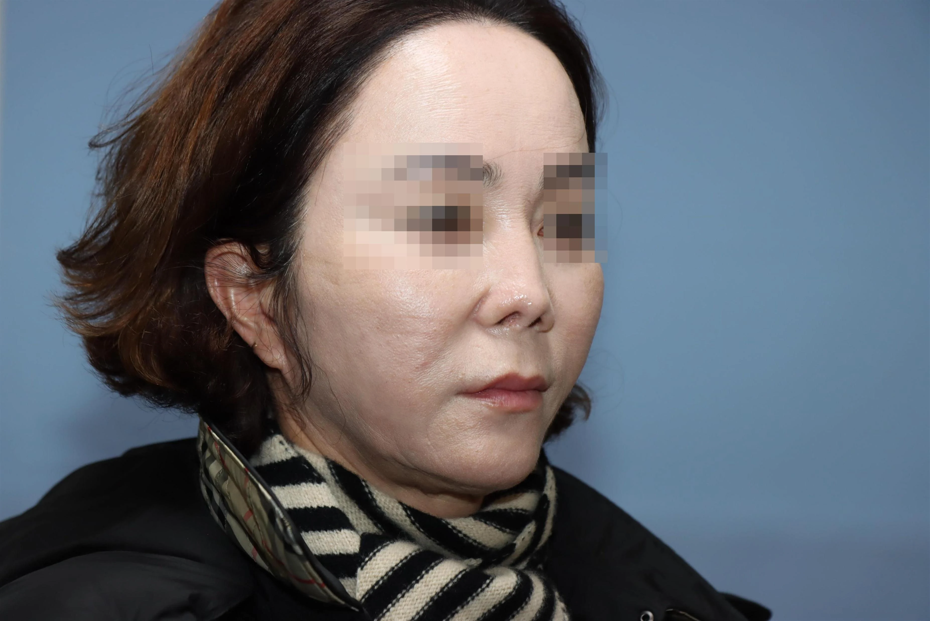 줄기세포 코성형 재건 수술 후 10개월 비교 사진 2