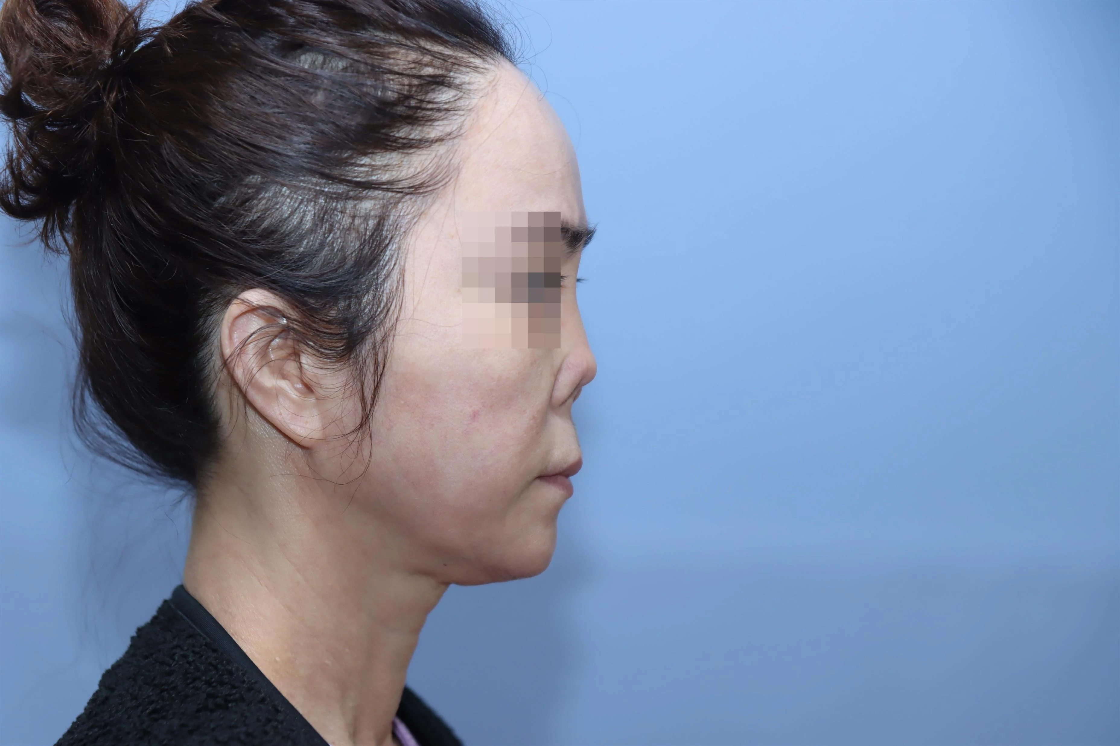 줄기세포 코성형 수술 전 비교 사진 1