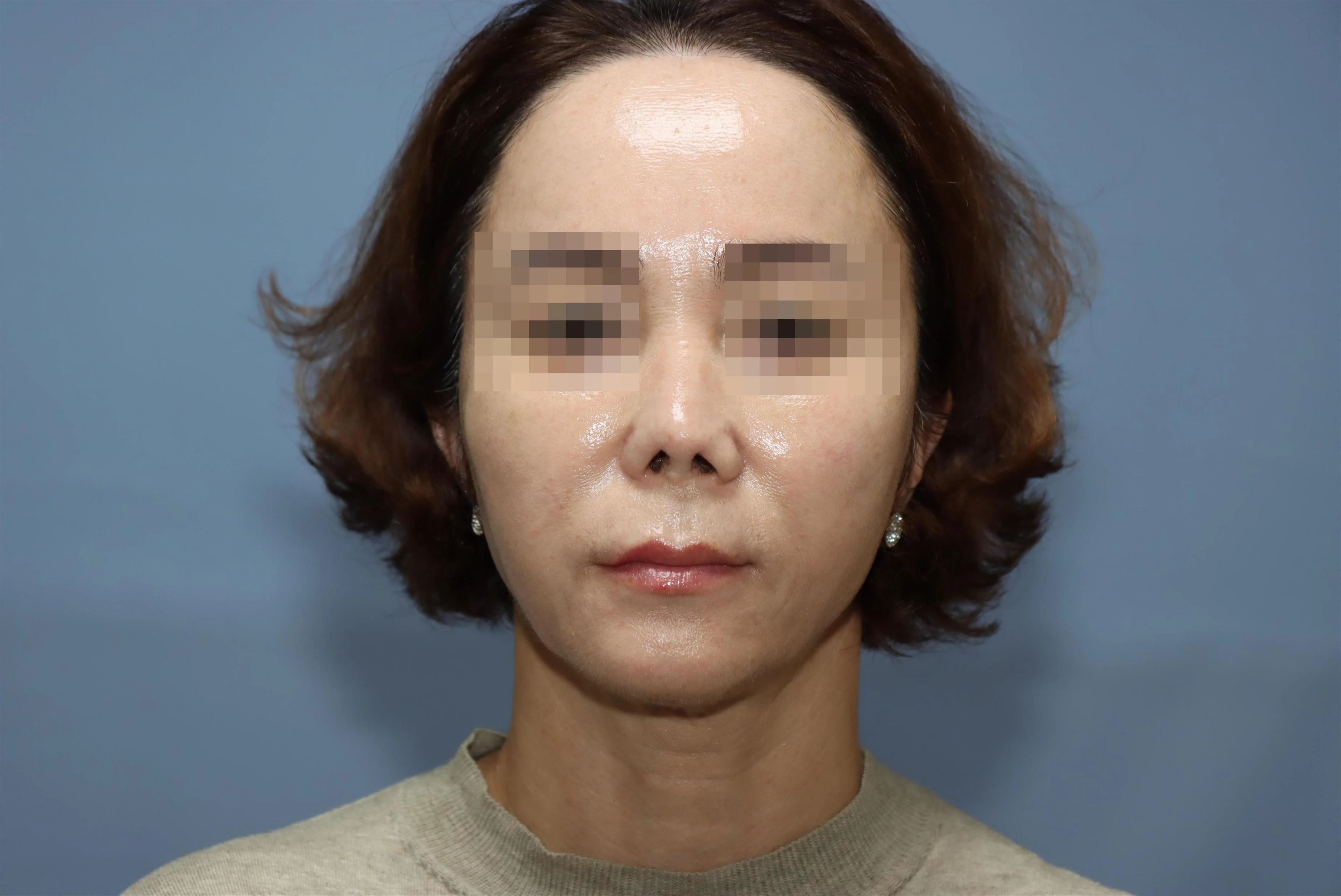 줄기세포 코성형 1차 재건 수술 후 8개월 비교 사진 2