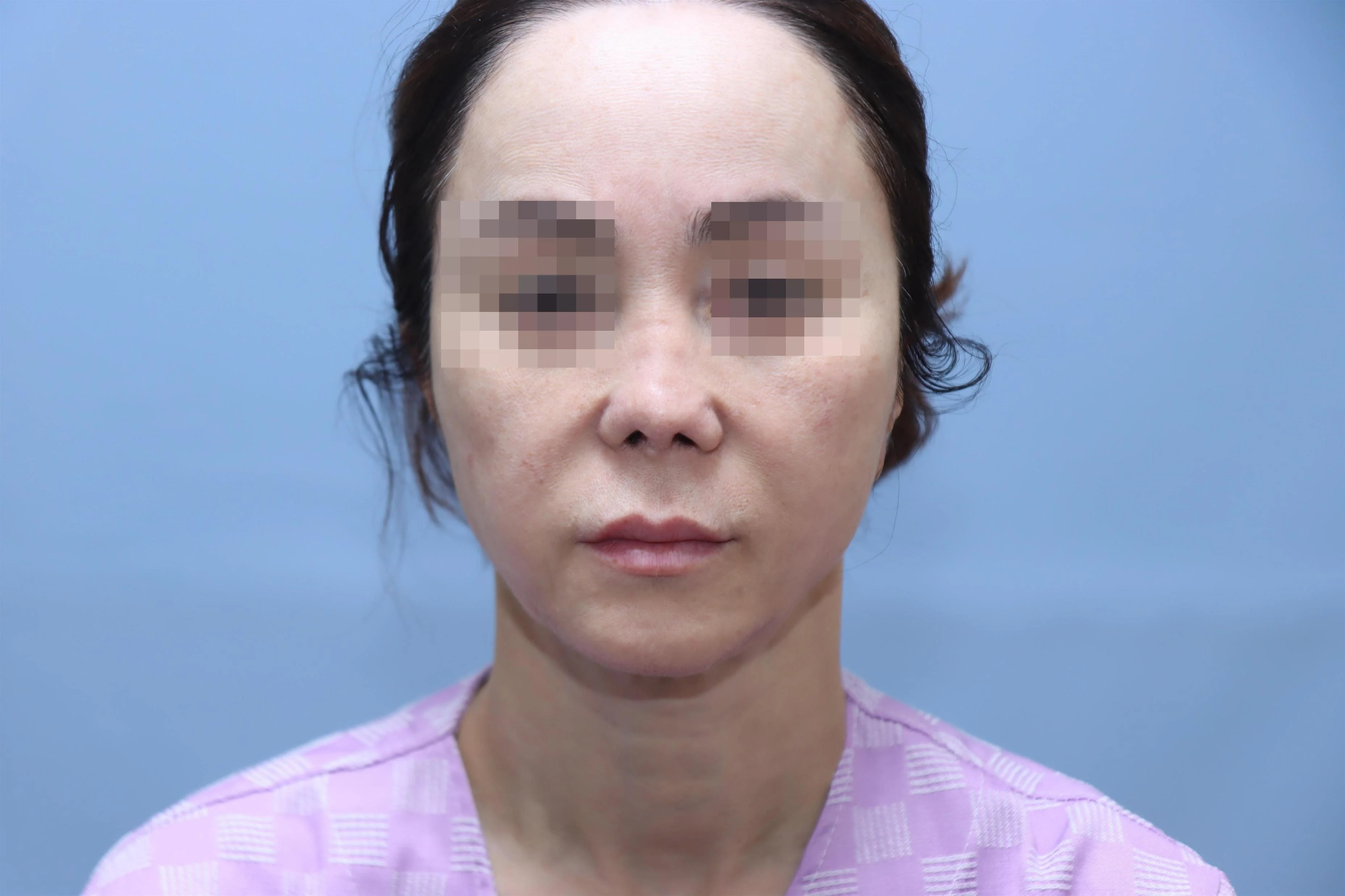 줄기세포 코성형 1차 재건 수술 후 3개월 비교 사진 1