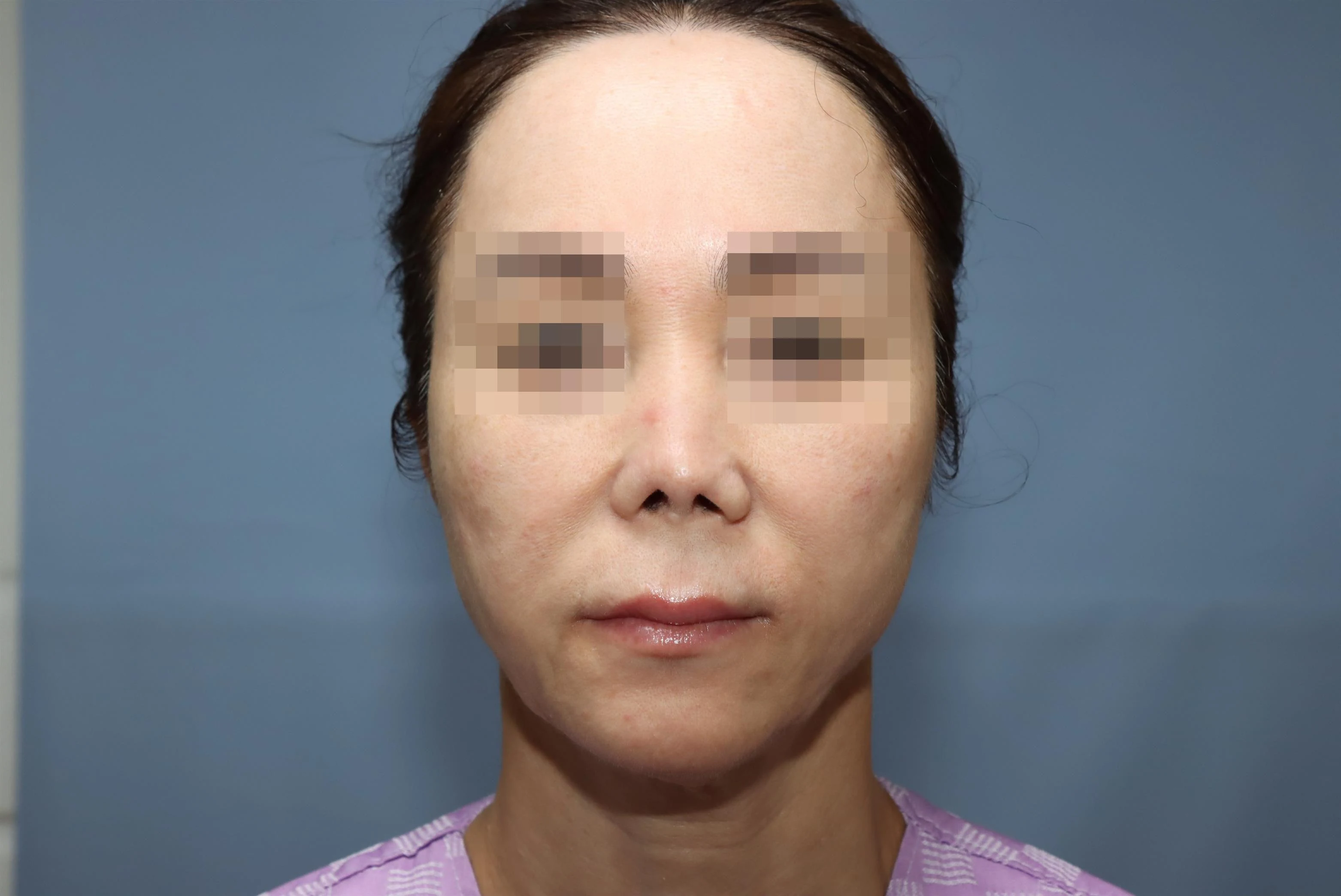 줄기세포 코성형 1차 재건 수술 후 2년 비교 사진 3
