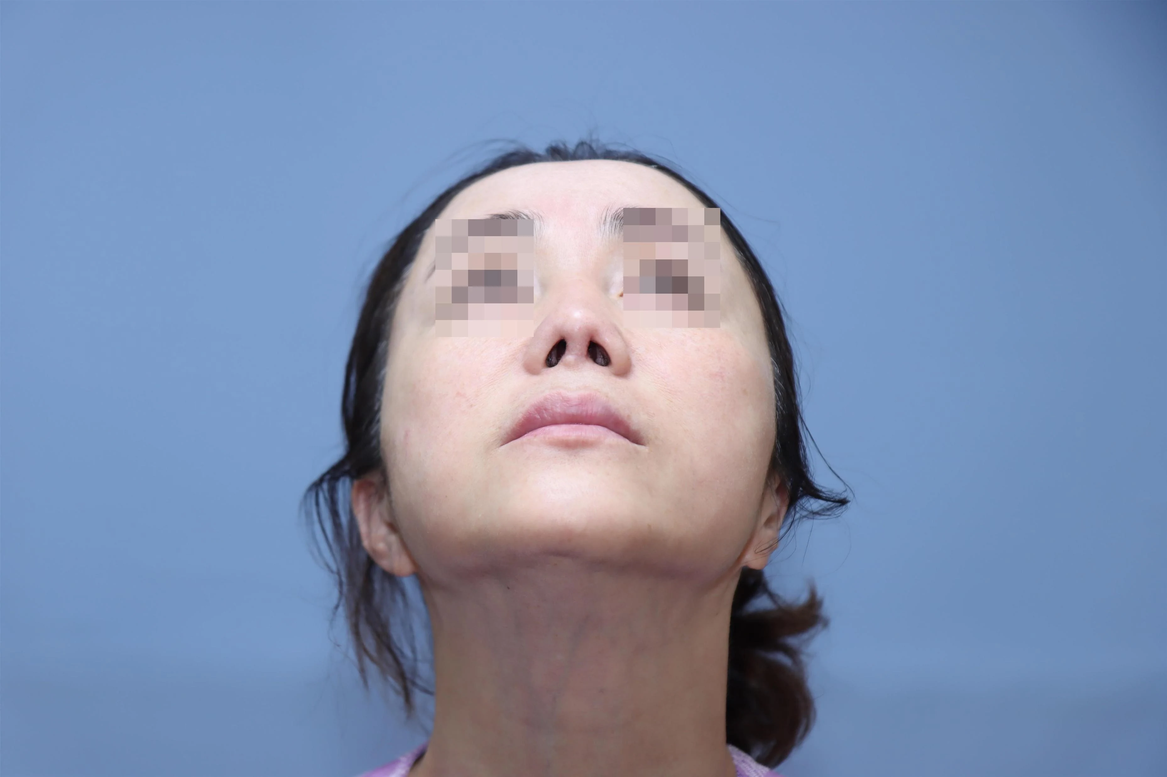줄기세포 코성형 3개월 비교 사진 1