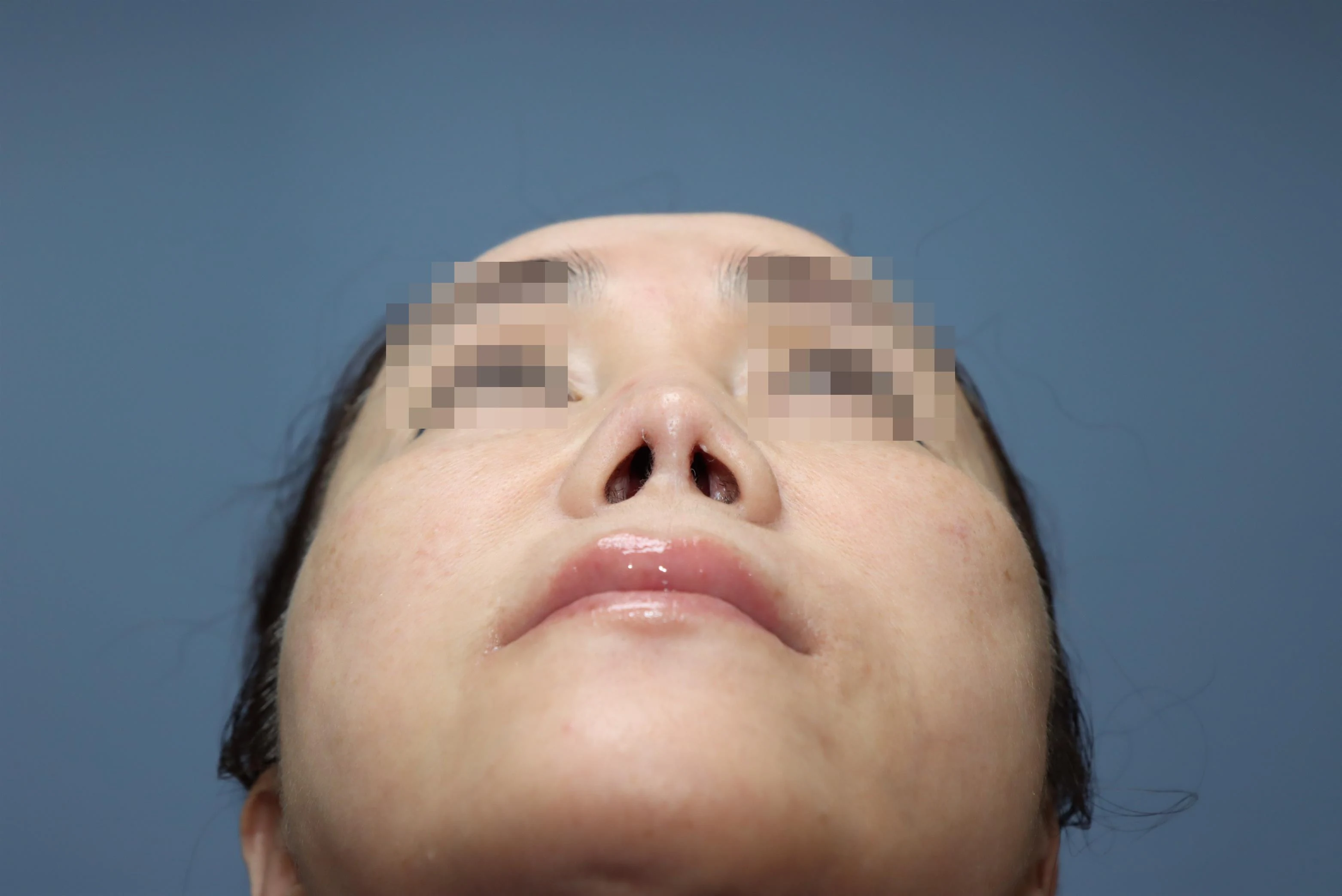 줄기세포 코성형 2년 비교 사진 3