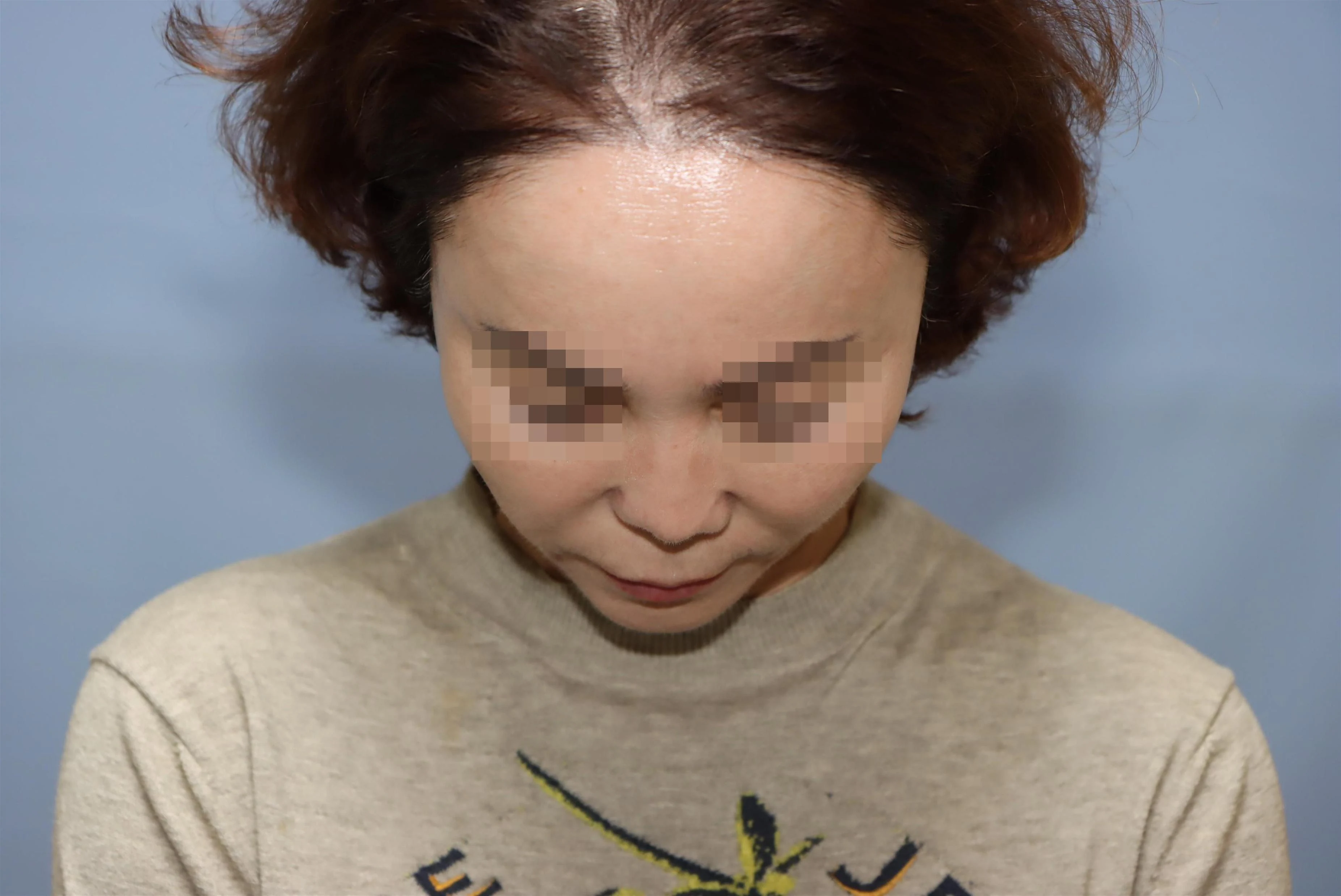줄기세포 코성형 1차 재건 수술 후 8개월 비교 사진 2
