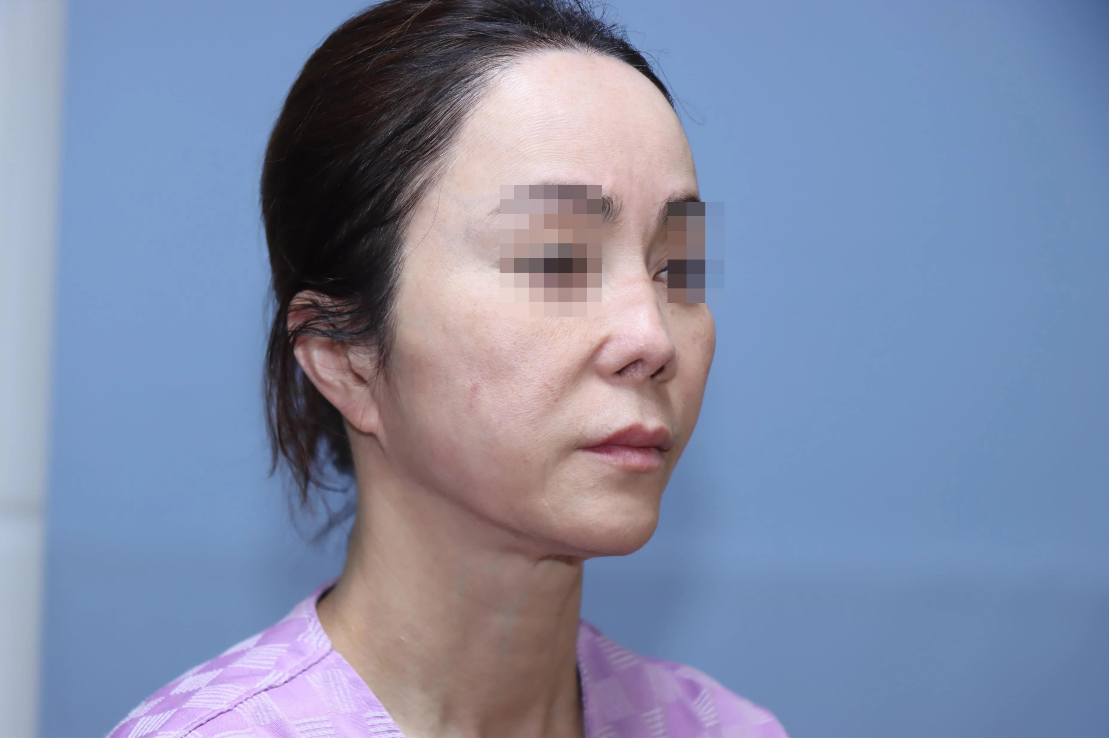 줄기세포 코성형 3개월 비교 사진 1