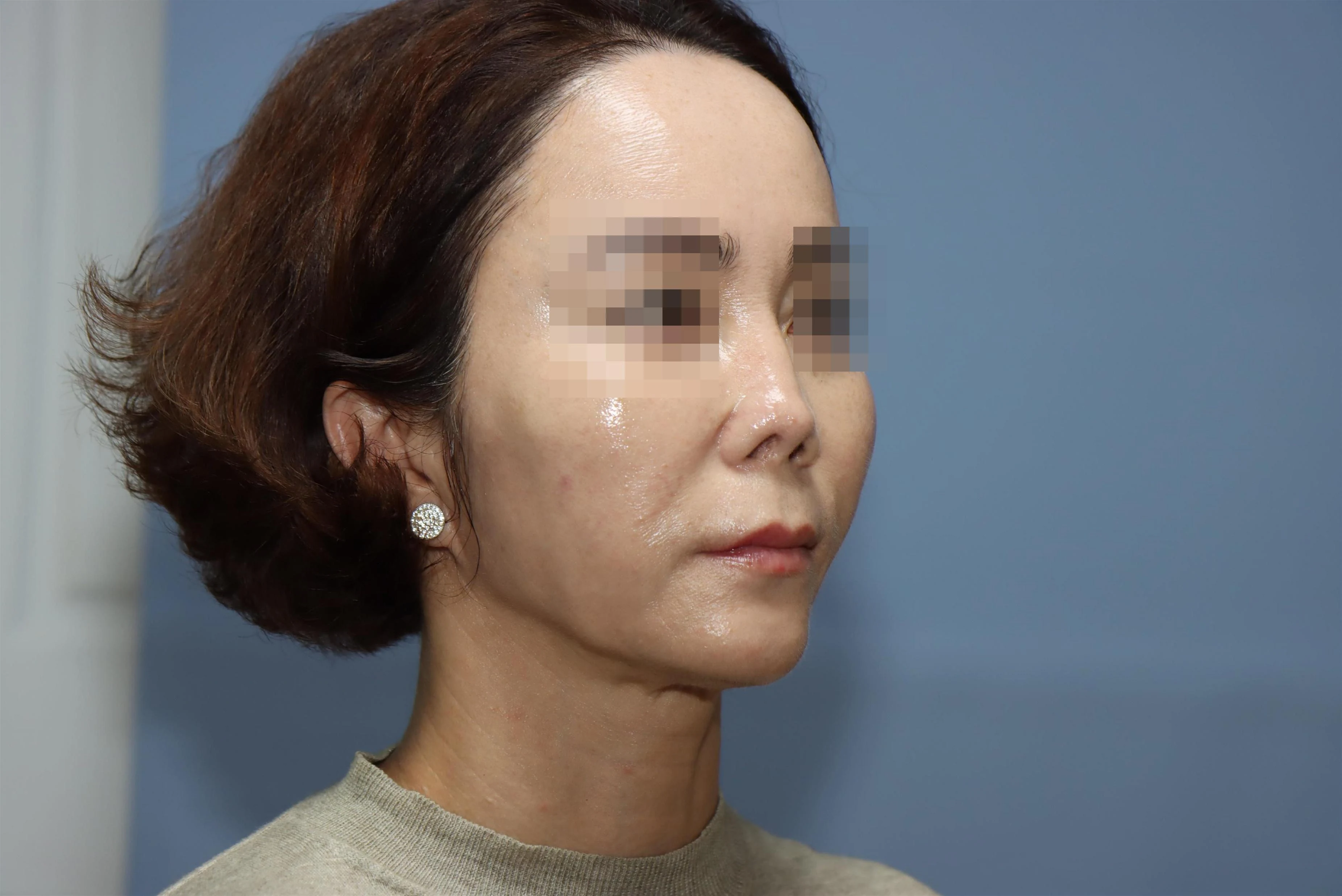 줄기세포 코성형 8개월 비교 사진 2