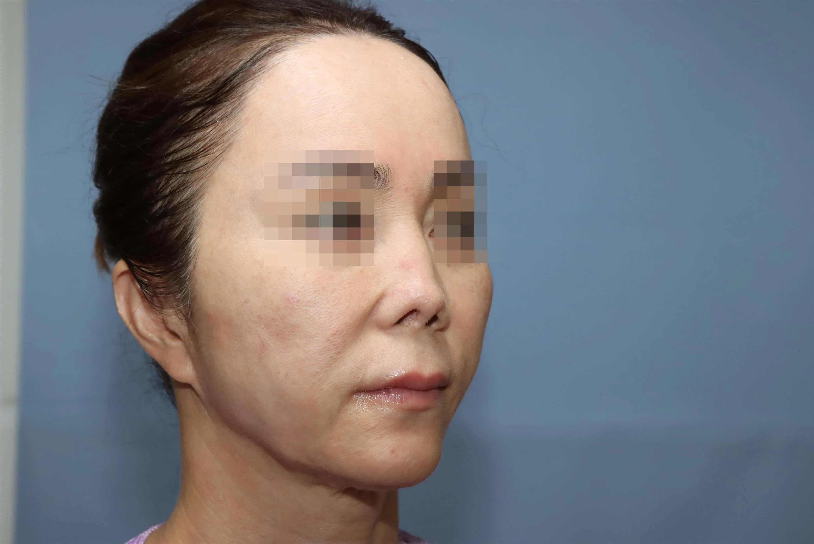 줄기세포 코성형 2년 비교 사진 3