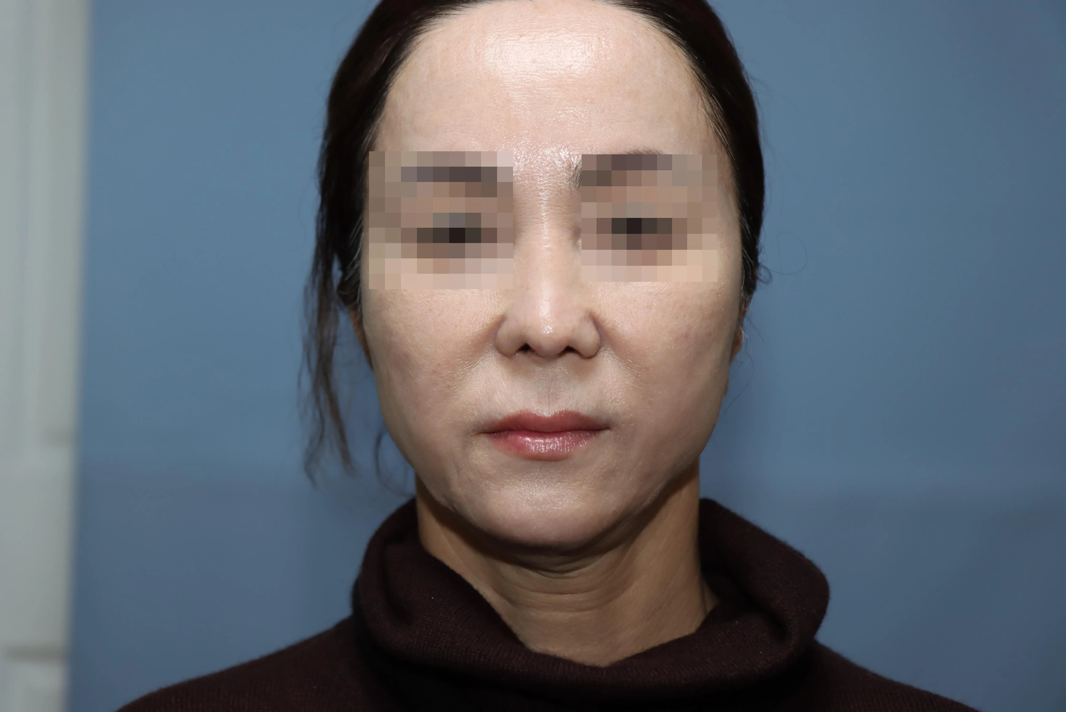 줄기세포 코성형 수술 후 5개월 비교 사진 2