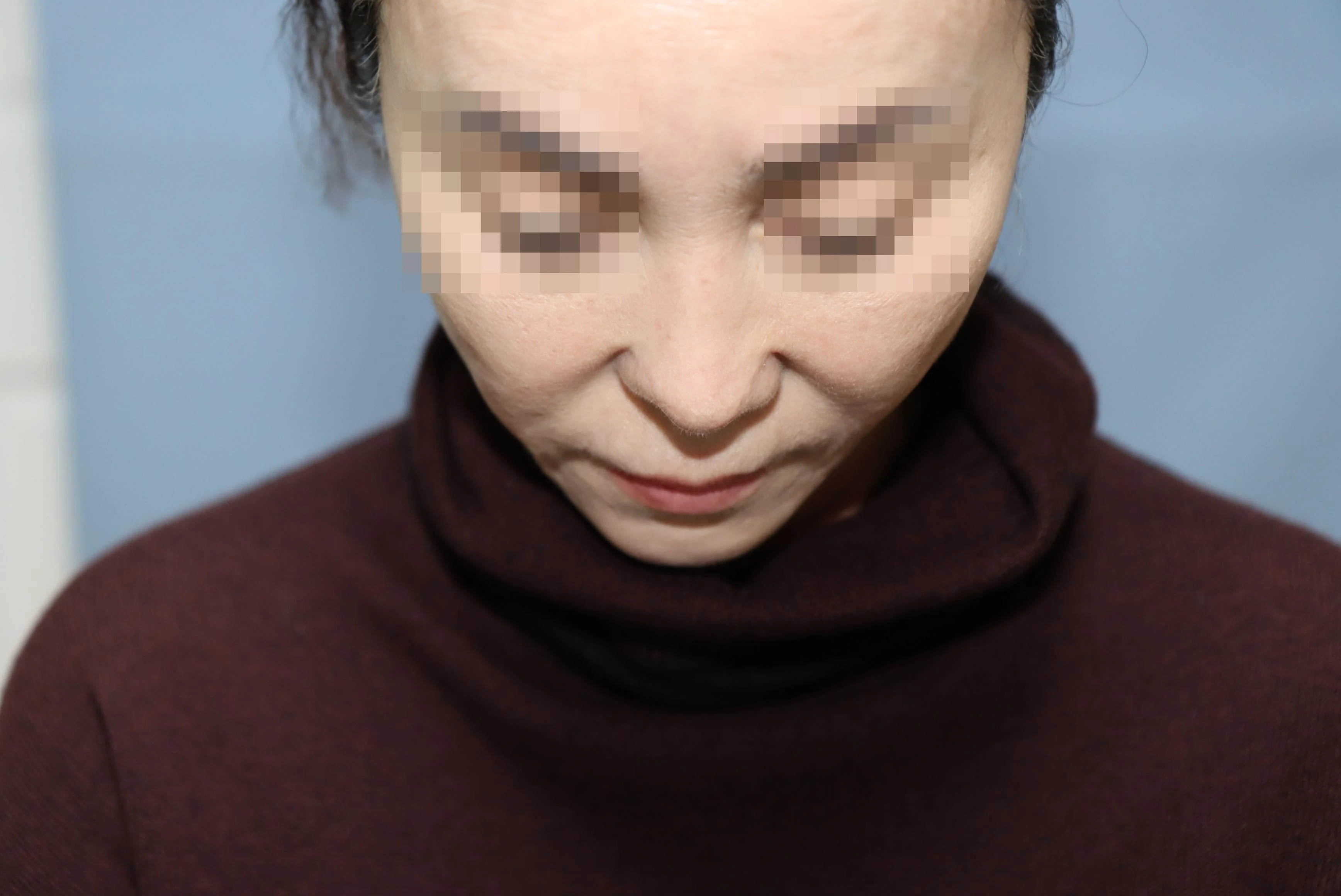줄기세포 코성형 수술 후 비교 사진 2