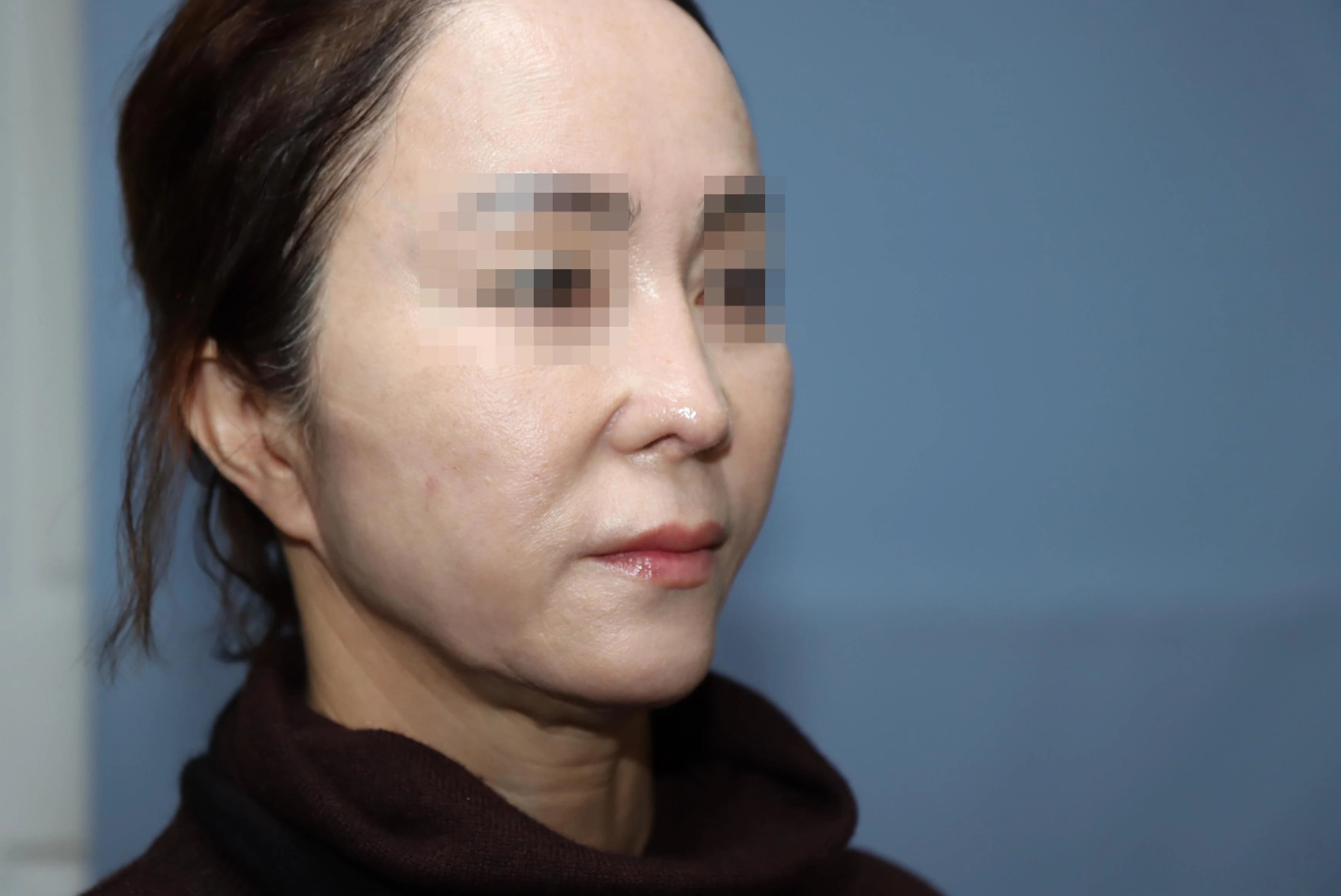 줄기세포 코성형 수술 후 비교 사진 2