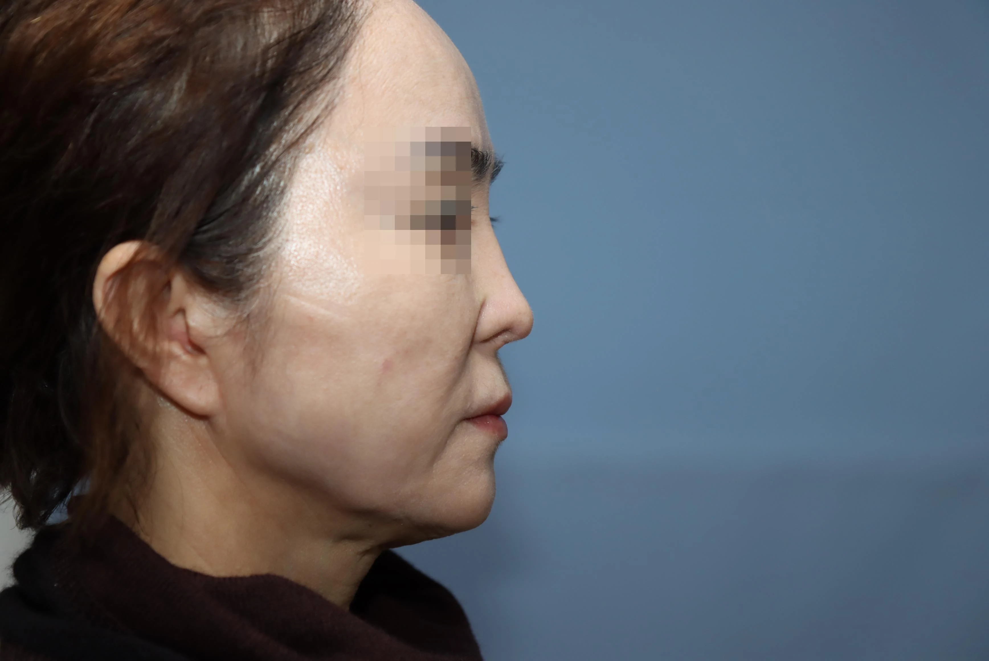 줄기세포 코성형 수술 후 비교 사진 2