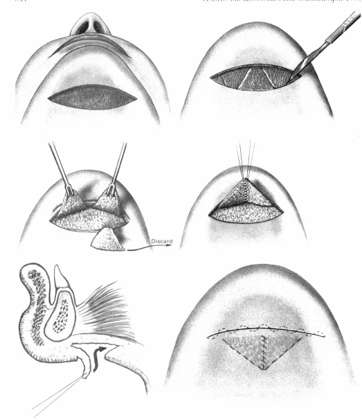 3. 턱밑 피판술 (Submental flap technique)