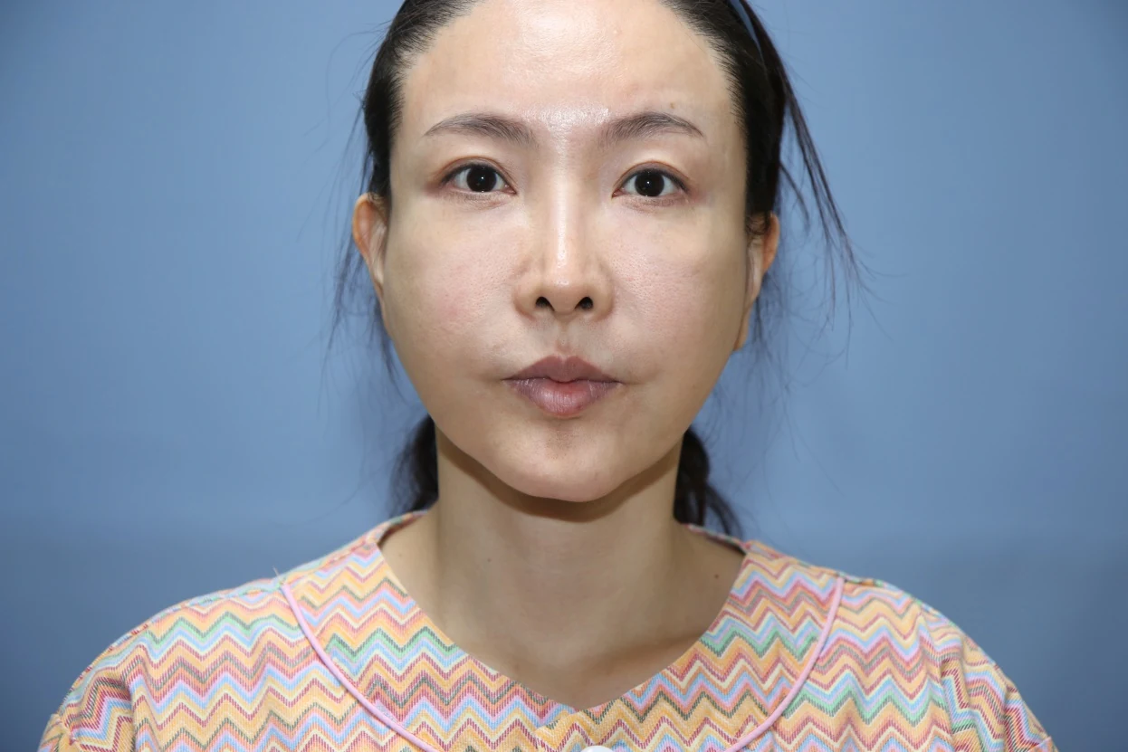 앞턱 올림술 사례 1 수술 전 비교 사진 1