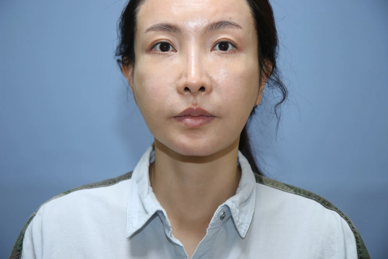 앞턱 올림술 사례 1 수술 후 3개월 비교 사진 2