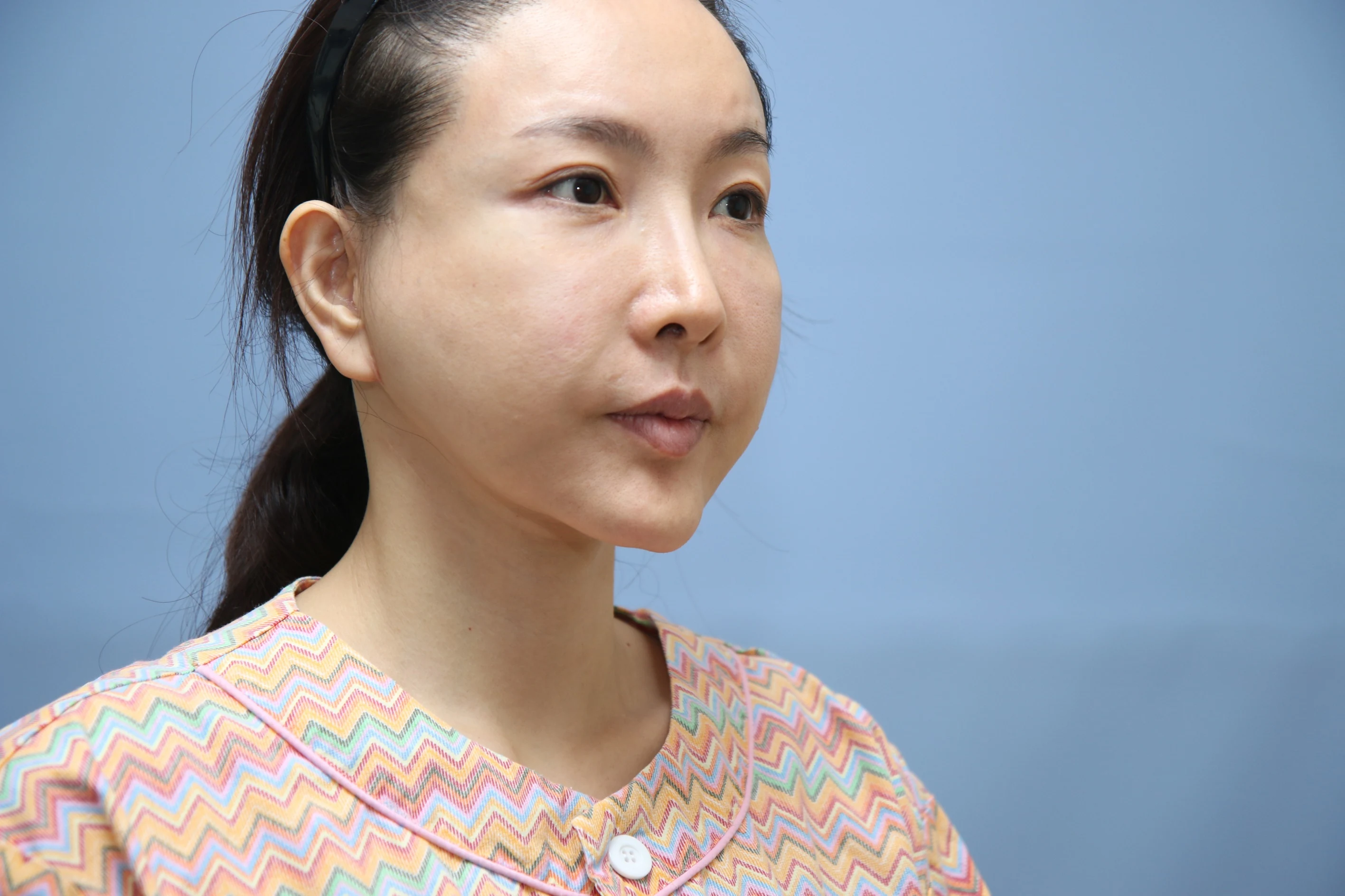 앞턱 올림술 사례 1 수술 전 비교 사진 1