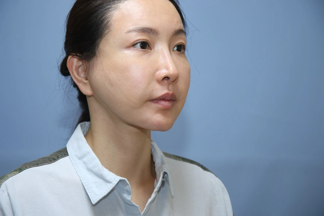 앞턱 올림술 사례 1 수술 후 비교 사진 2