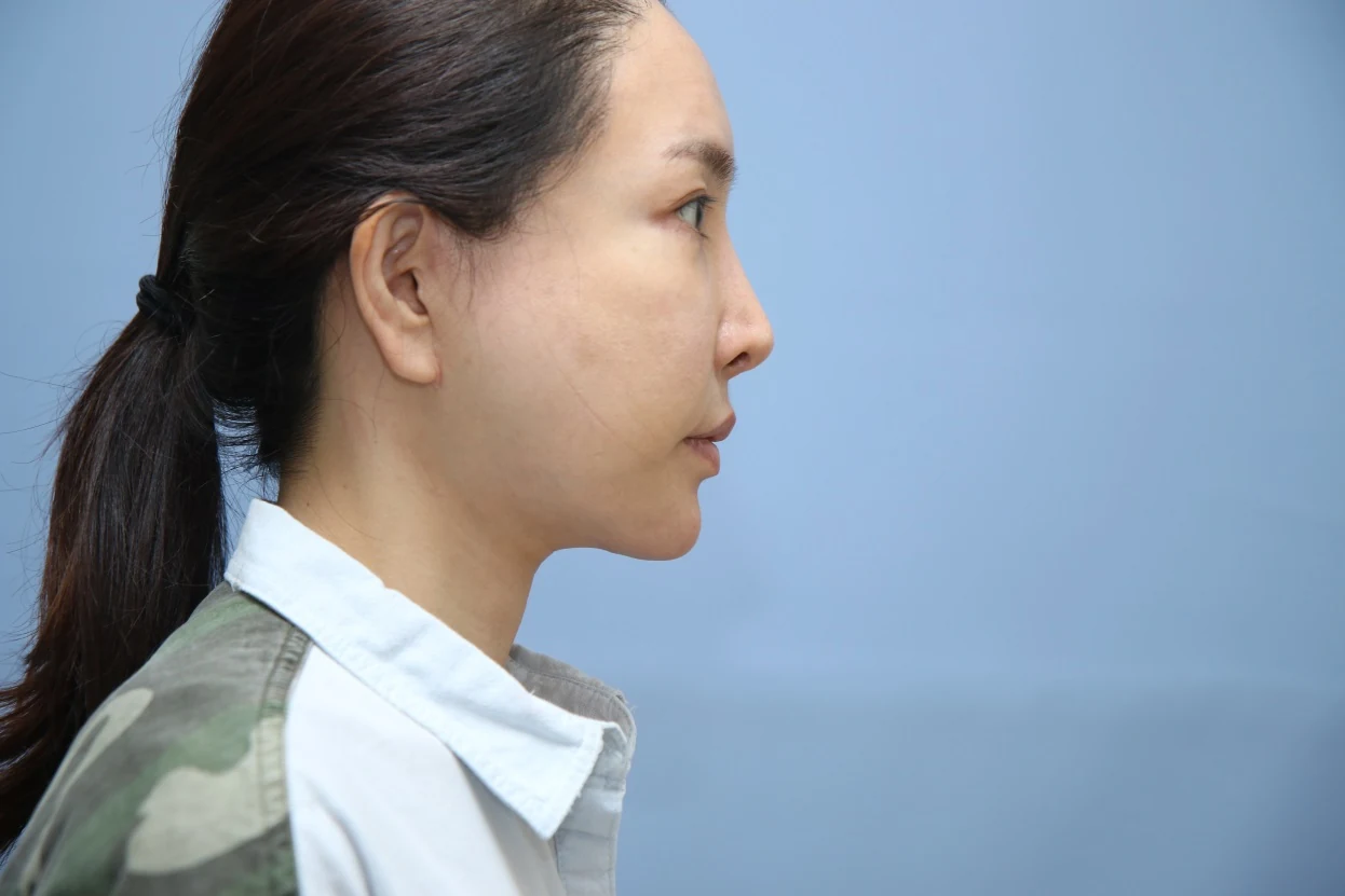 앞턱 올림술 사례 1 수술 후 비교 사진 2