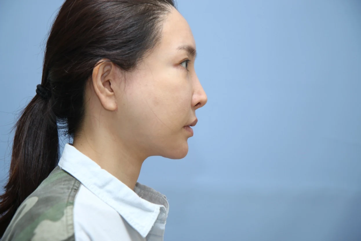 앞턱 올림술 사례 1 수술 후 비교 사진 2