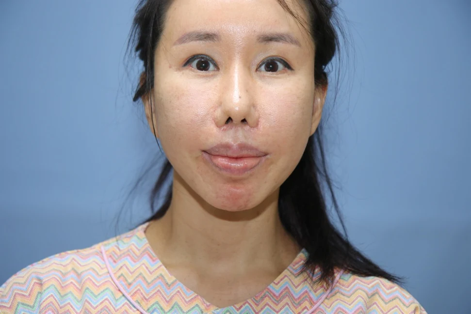 앞턱 올림술 사례 3 수술 전 비교 사진 1