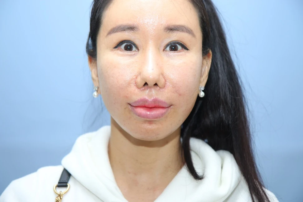 앞턱 올림술 사례 3 수술 후 2달 비교 사진 2