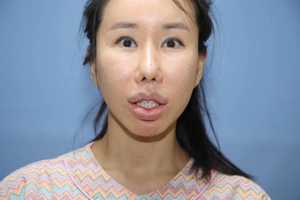 앞턱 올림술 사례 3 수술 전 비교 사진 1