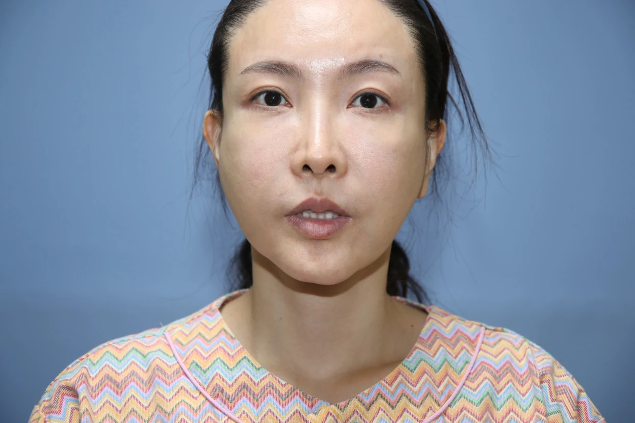 02. 입술이 아래로 떨어짐