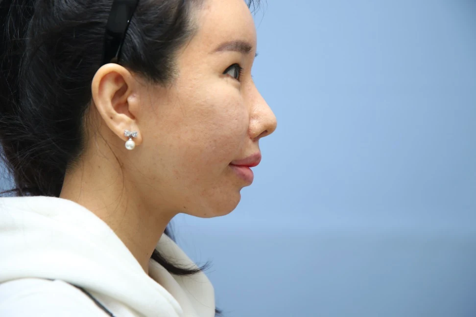 앞턱 올림술 사례 3 수술 후 비교 사진 2