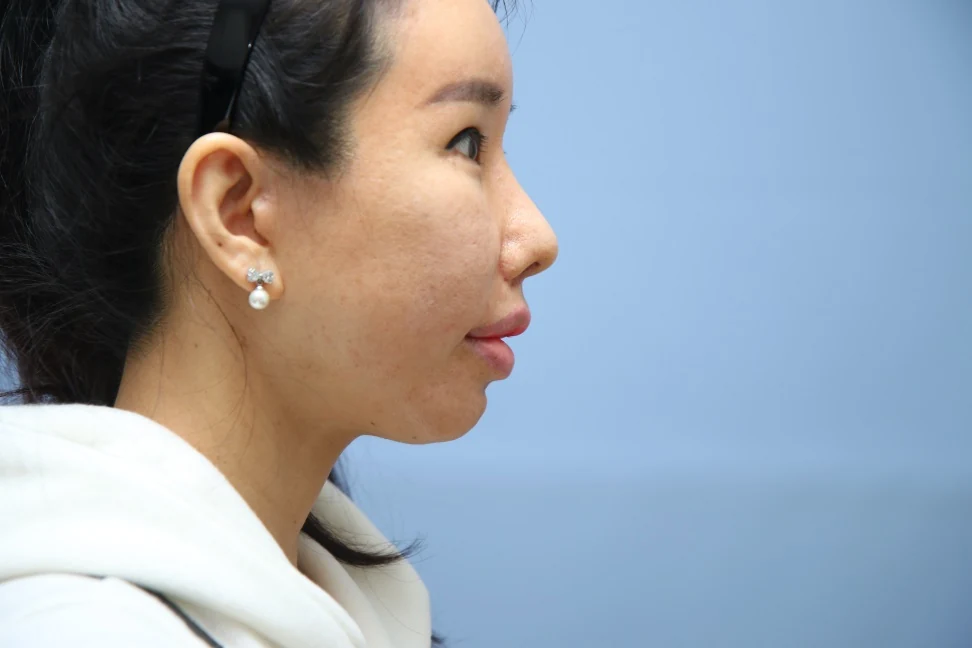 앞턱 올림술 사례 3 수술 후 비교 사진 2