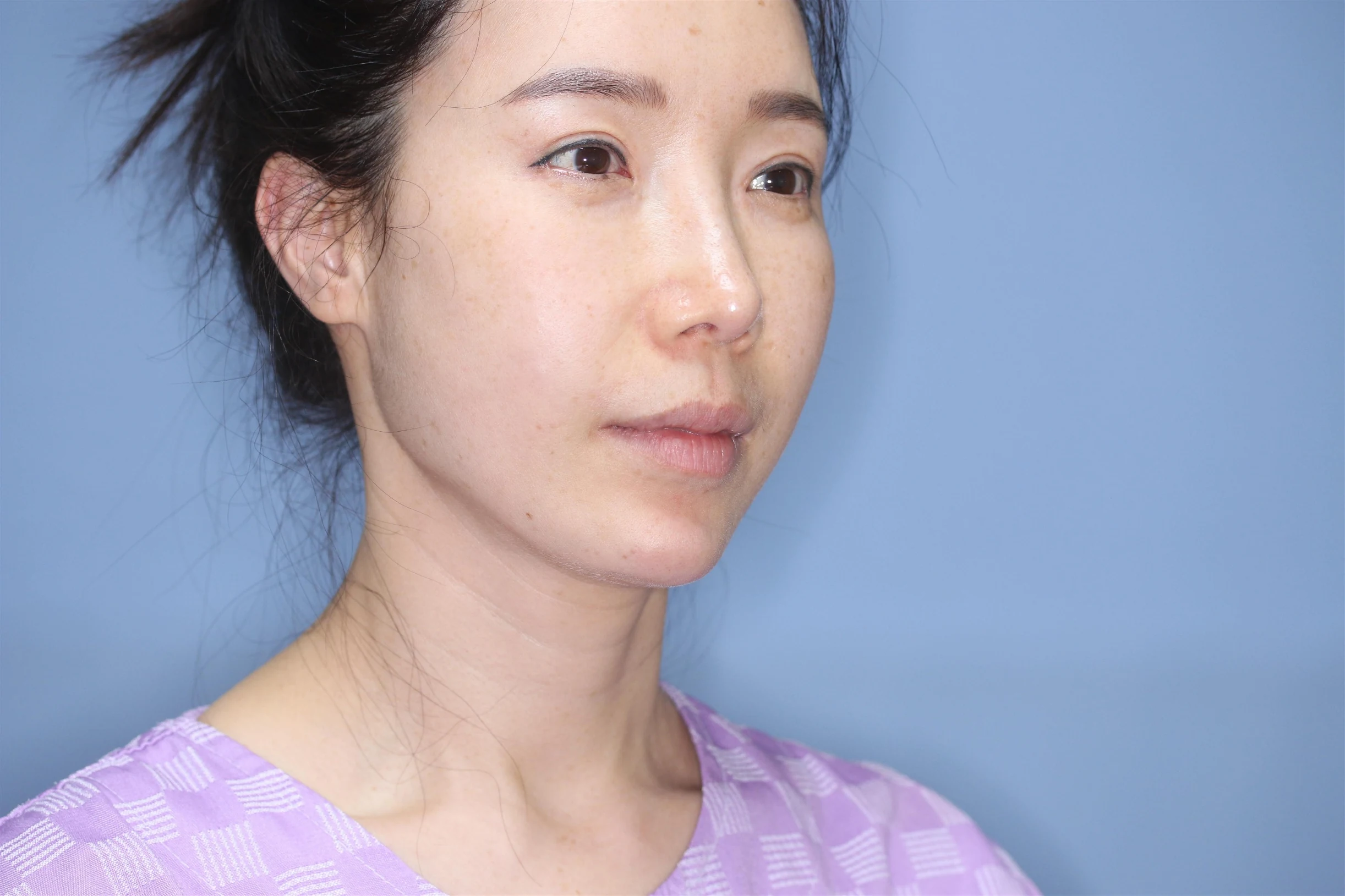 앞턱 올림술 사례 4 수술 전 비교 사진 1