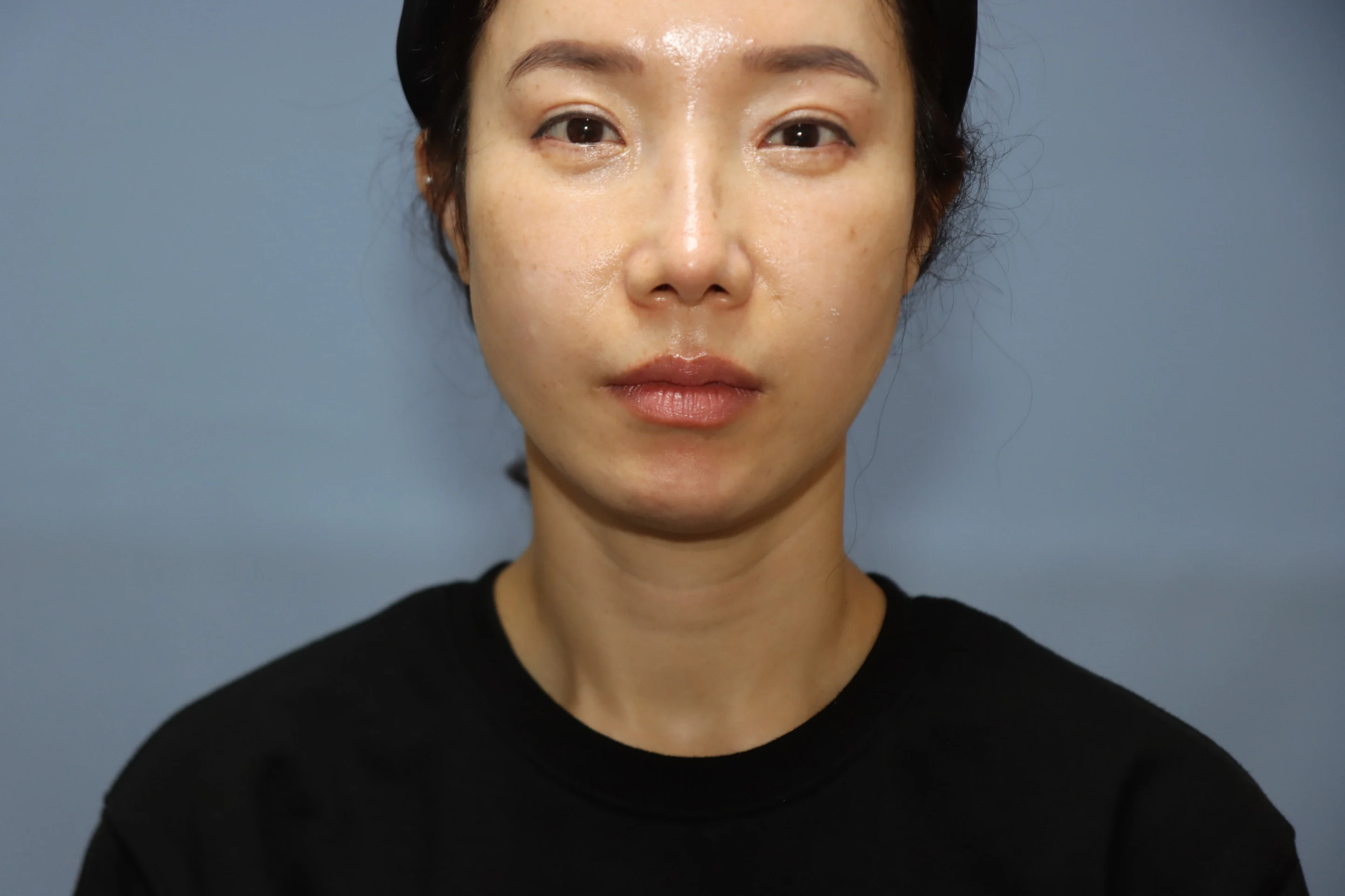 앞턱 올림술 사례 4 수술 후 3개월 비교 사진 2