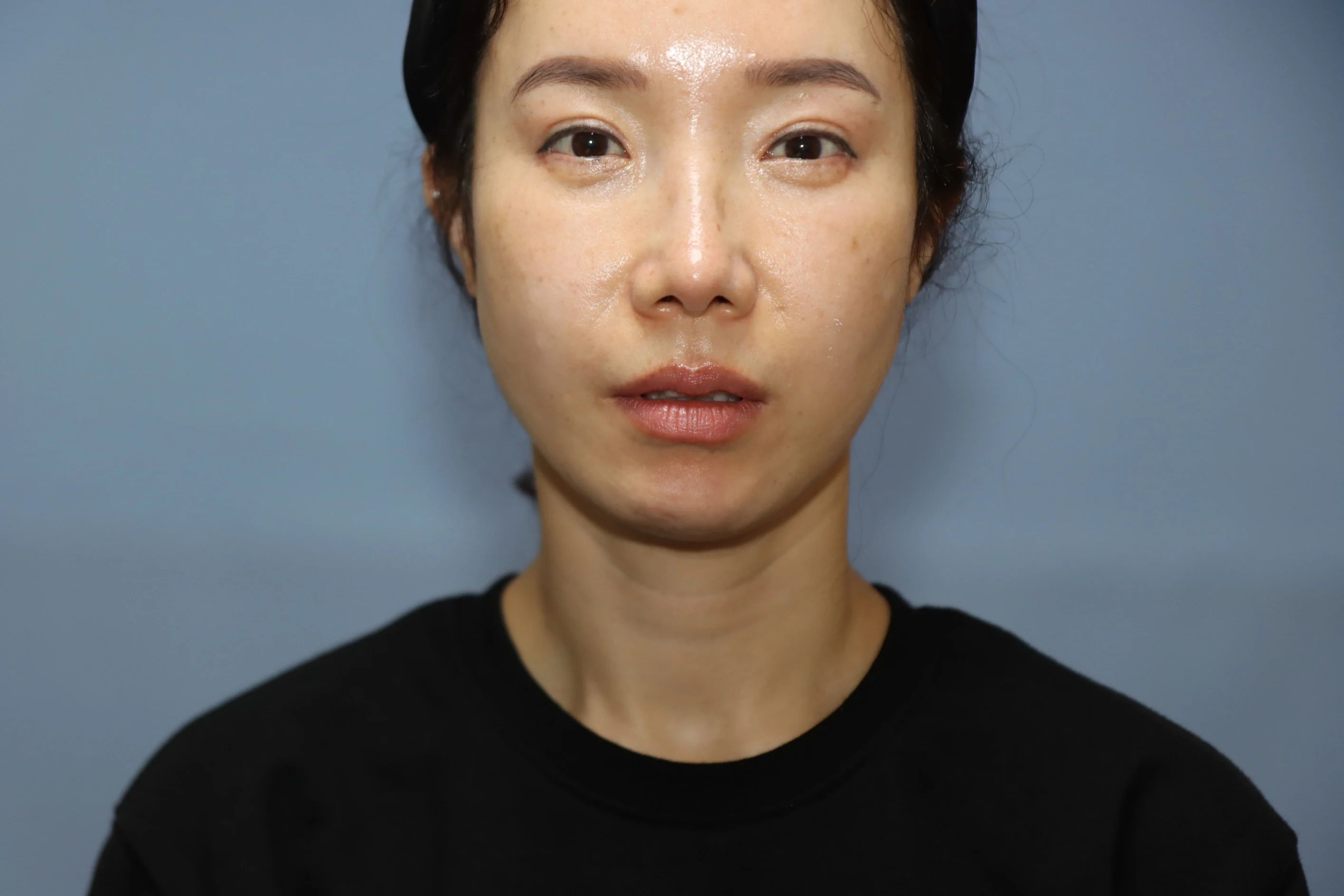 앞턱 올림술 사례 4 수술 후 3개월 비교 사진 2
