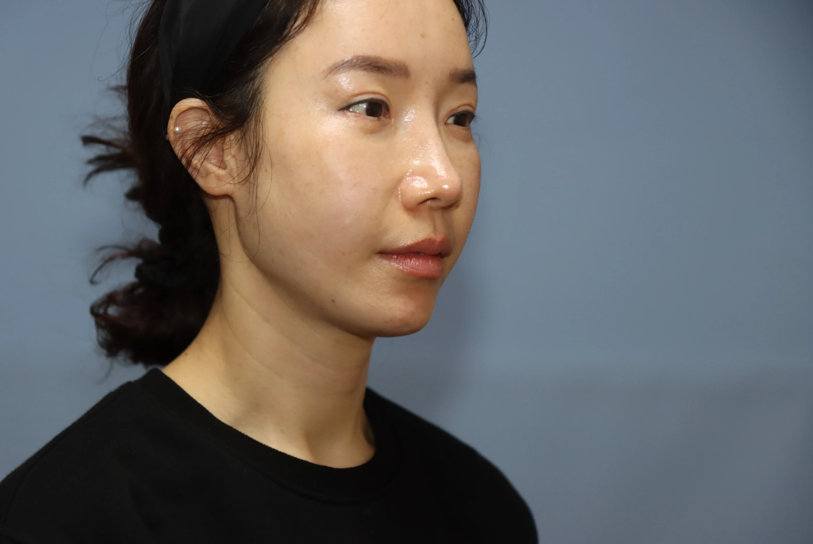 앞턱 올림술 사례 4 수술 후 비교 사진 2