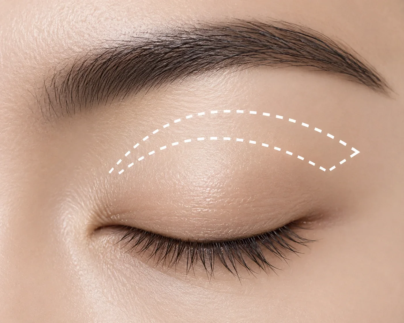 상안검 성형 SUTURE 안내 이미지