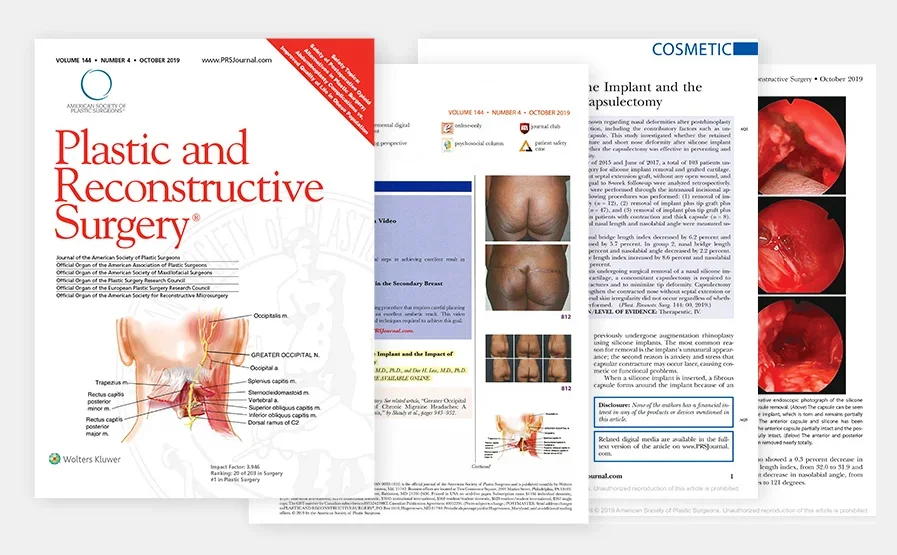 Impact of the unremoved peri-implant capsule and
subsequent subtotal capsulectomy on the nasal length after extracting nasal silicon implant