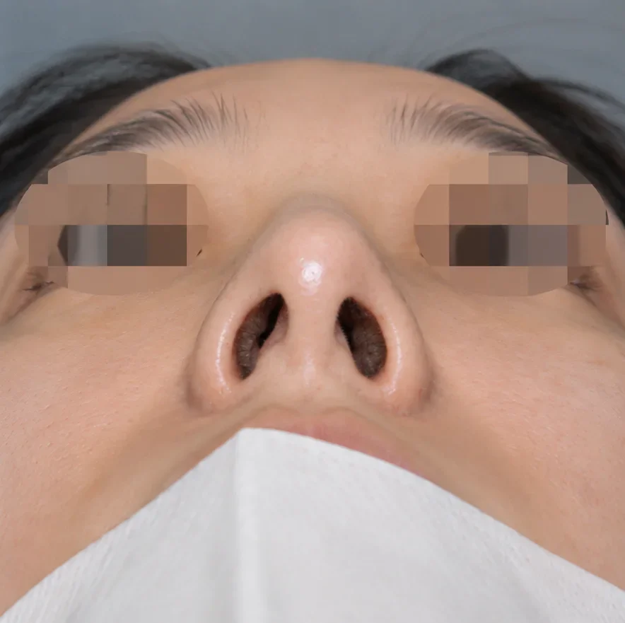 콧구멍이 짝짝이고 코 기둥이 기울어짐
