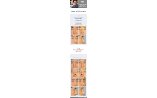 남자코재수술03_ 휜코, 화살코 수술의 미흡한 수술 결과를 교정