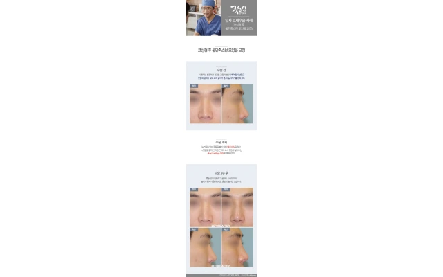 남자코재수술05_ 코성형 후 불만족스런 모양을 교정